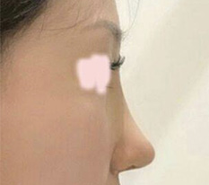 分享鼻部手术后的心得，大家觉得怎么样？？
