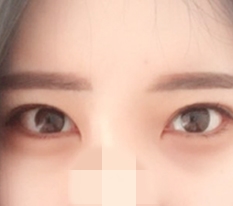 外眼角开大术和下眼睑切开！