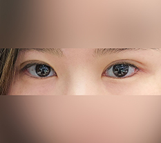 眼部手术改变了我的印象