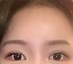 3个月的额头提升