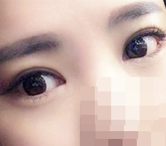 眼部切开+眼肌矫正+前、后、下开眼角