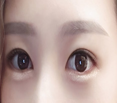 自然粘连+后下开眼角第4个月