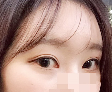 眼部手术太棒了>.<