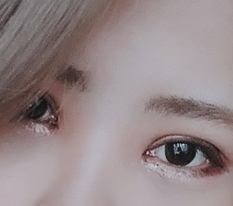 Eye surgery is the best!