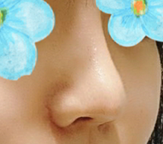 鼻修复超级满意☆