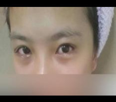 双眼皮（切开）和双重开眼角太喜欢了:D