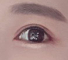 满意满意的眼部整形
