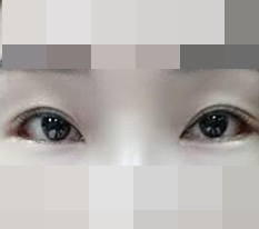 后眼角+下眼角开大评价