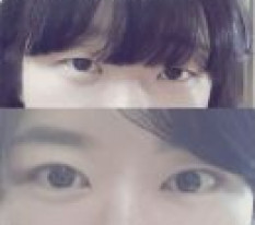 做完眼部手术后都说我变漂亮了~ haha
