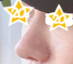 男人就是鼻子！在现代美学整形外科成功了