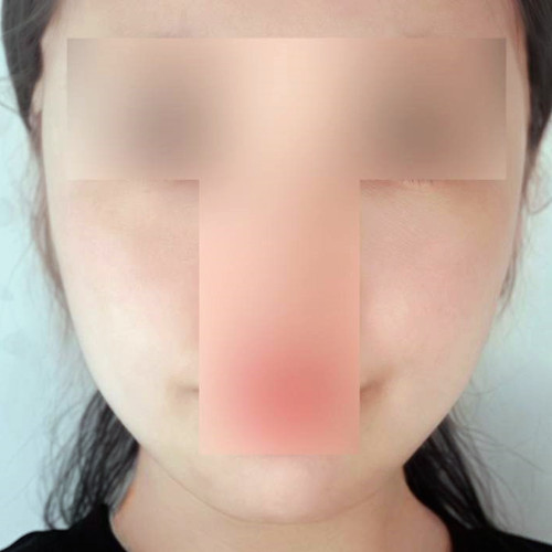 下巴肉下垂、脸颊下垂做线雕提升