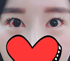 I had revision rear/lower canthoplasty. Please see if it went well