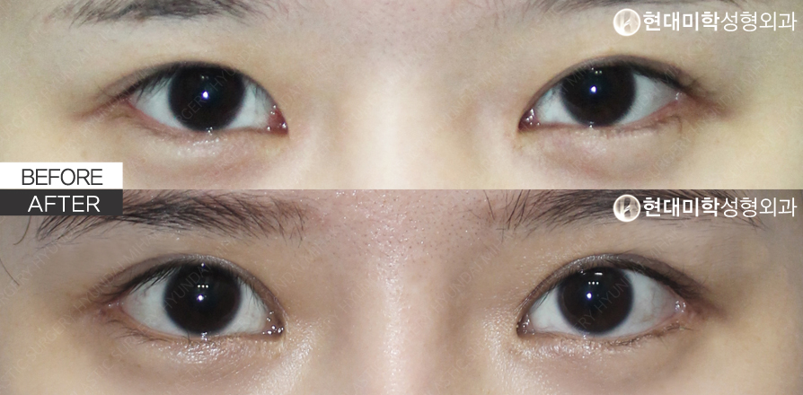 切开式眼型矫正（修复手术）