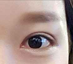 在现代美学成功做双眼皮和开眼角的故事~