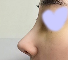 鼻子修复手术已经2周了~~！