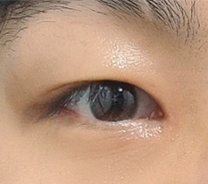 开眼角失败后..