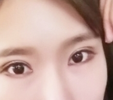 不想再单眼皮了