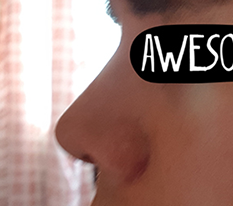 6-month nose surgery review