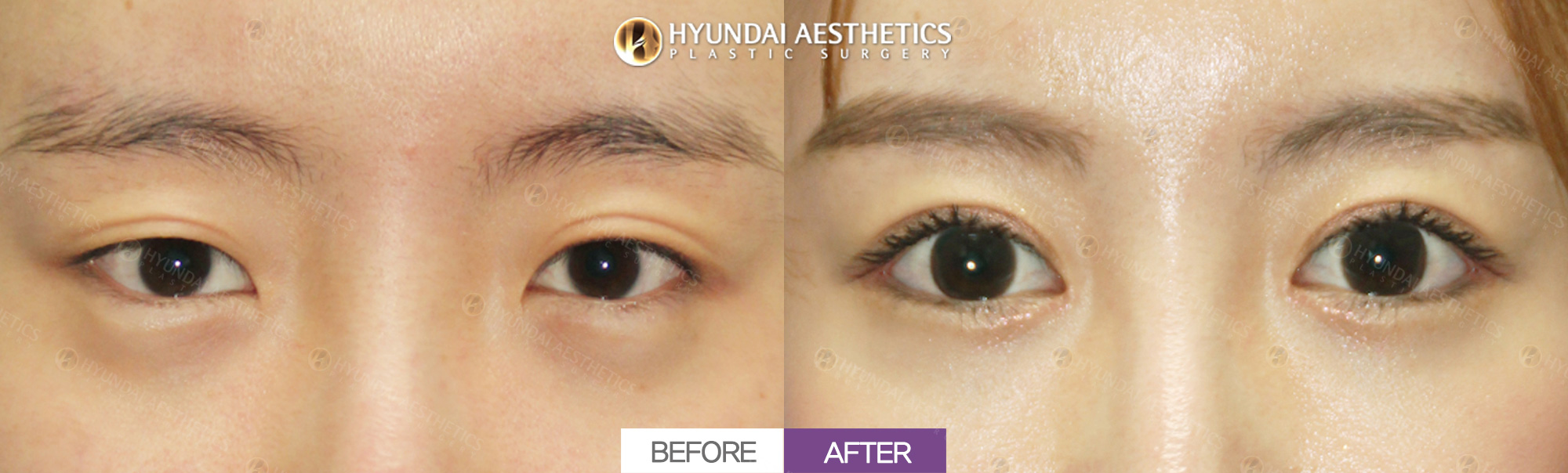 切开眼型矫正 + 双眼皮 + 开内眼角 + 开外眼角 + 下至术 术后1个月