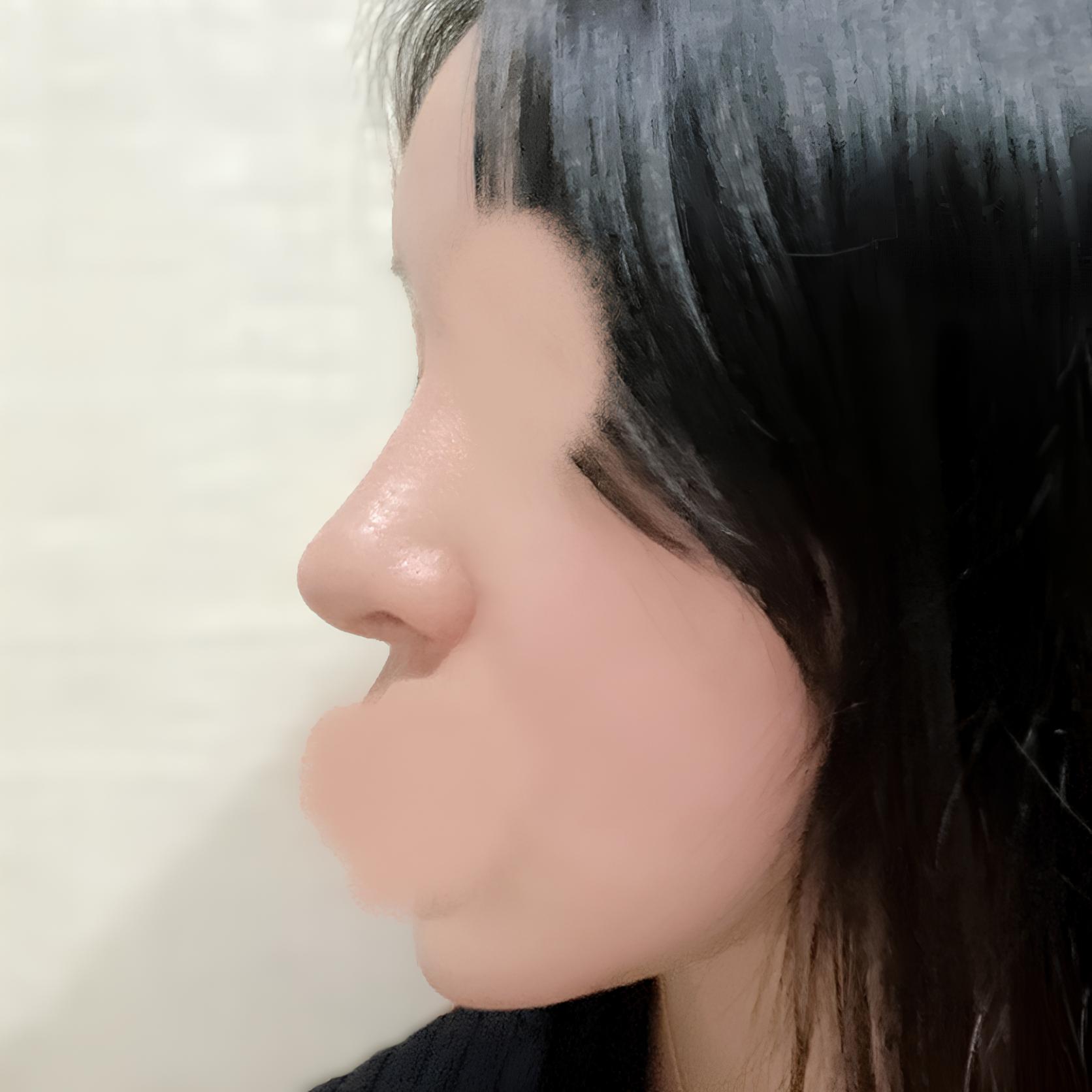 从蒜头鼻变成秀气直微翘鼻