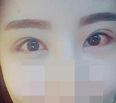 眼部修复+开外眼角+下至+开内眼角评价+_+