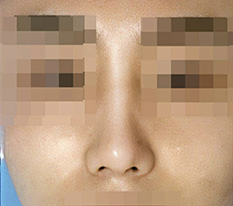 男士鼻手术2个月后的评价。