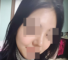 现代美学整形外科把我短又胖的蒜头鼻变漂亮了^_^