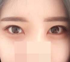 多亏了双开眼角手术