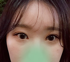 通过眼神矫正和开眼角成功改变形象 :)