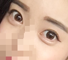 I Had Eye Incision and Epicanthoplasty