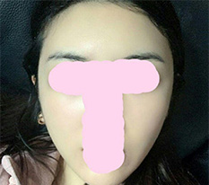 颧骨手术已经一个月了 ^^