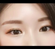 来留个眼部手术体验^^