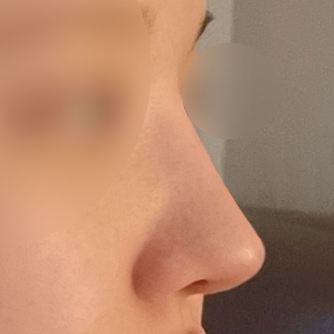 25年人生里丑鼻子做鼻整形的评价