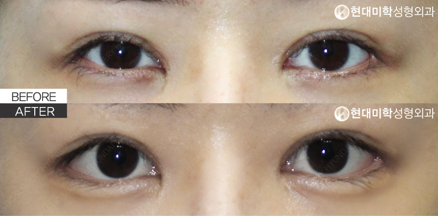 非切开卧蚕 + 双重开眼角（修复手术）
