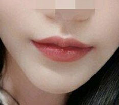 期待已久的提口角手术6个月后的心得 ㅜㅜㅜㅜㅜㅜ