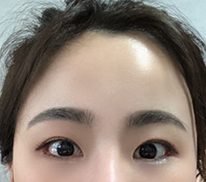 额头提升第3个月啦