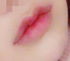 I highly recommend 现代美学整形外科 mouth-corner + Cupid lip surgery