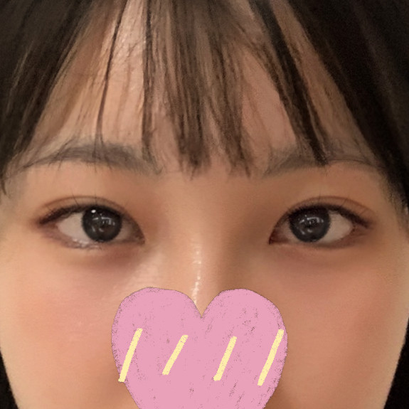 小眼睛开眼角和双眼皮修复评价