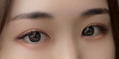 #眼部修复 #切开双眼皮修复 #双重开眼角 #提肌矫正