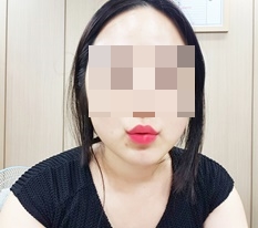 留下嘴角手术评价!!