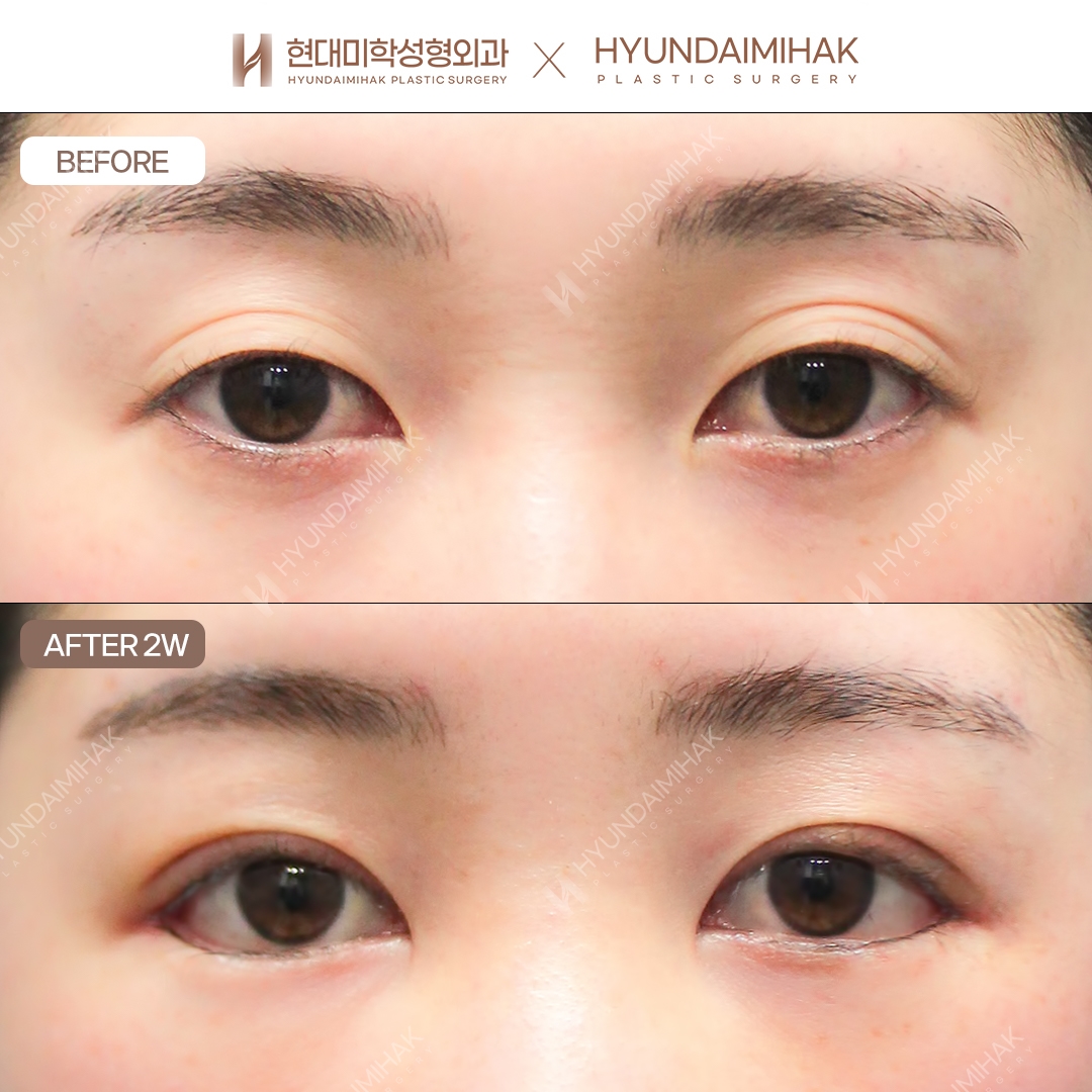 [大小眼矫正] 切开双眼皮 + 眼型矫正 + 双重开眼角