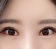 眼型矫正名店现代美学整形外科
