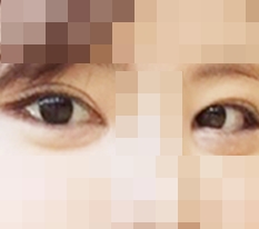 我做了眼部修复和全套开眼角!!