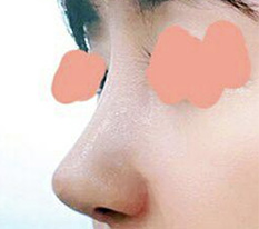 来发一下鼻修复评价 haha
