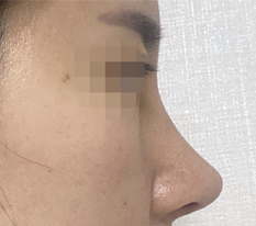 通过熟人推荐在现代美学整形外科做了鼻子手术