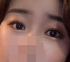 有双眼皮就不做眼部整形，真的很吃亏哈哈 (双重开眼角+开内眼角后记)