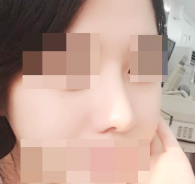 鼻部整形最棒，非常满意♥!!