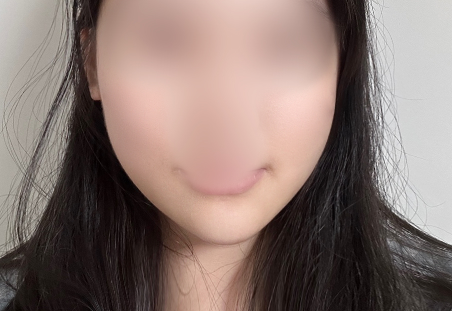 用埋线提升改善了面部不对称