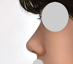 The best place for hump-nose surgery!