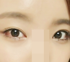 我做了Perfect Big Eye+双内外眦开大手术